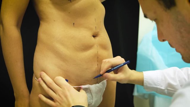 thick elderly woman prepares to medical liposuction. Doctor draws marker, mark on the abdomen. The surgeon draws the markup before the operation by liposuction on the patient to the woman.