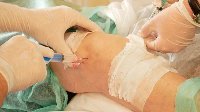 Medical surgery for knee - the doctor and nurse drains the liquid from the patient's knee with a syringe