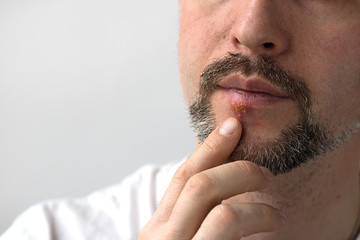 Fototapeta premium Medicine Illness Herpes Man Beard Healthy