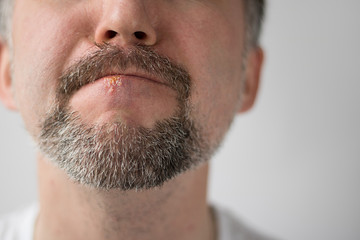 Obraz premium Medicine, Illness, Herpes, Zoster, Man, Beard, Healthy