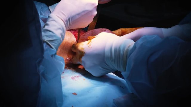 The introduction of the implant into the patient's chest during plastic surgery breast augmentation. The surgeon inserts under the skin a silicone implant of the female breast. Increases tits.