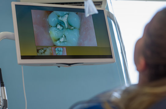 Great concept of dental procedure, young blond Brazilian woman in the dental chair suffering dental procedure by dentist as use of visualization monitor and image enlargement of the tooth.
