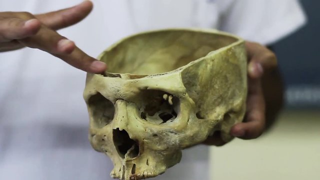 Forensic Scientist Measuring Human Skull 