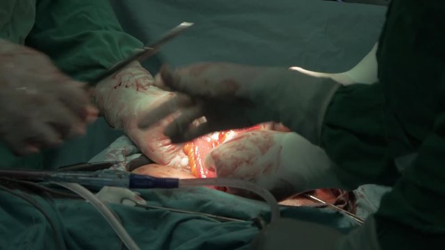 Explicit scene of hard surgery operation in operating room, surgeons hands in protective gloves using surgical instruments to processing cut of internal organ in abdominal area of patient, interior