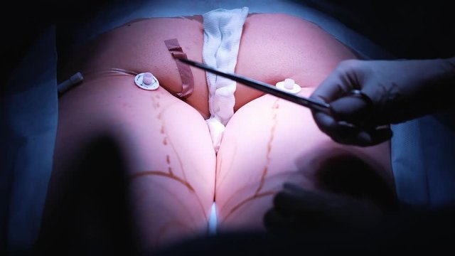 Operating room: preparations for liposuction surgery. a team of surgeons do the operation of liposuction to a girl. The surgeon works as a cannula
