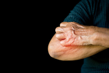 Old hands itching on arm in black background, dermatitis concept