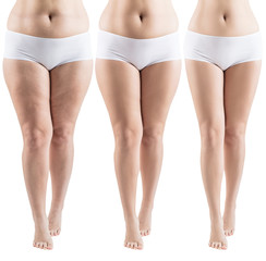 Woman legs before and after slimming. - obrazy, fototapety, plakaty