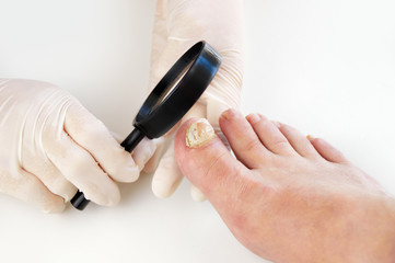 Close up image of left foot toe nail suffering from fungus infection. Checking it with magnifying...
