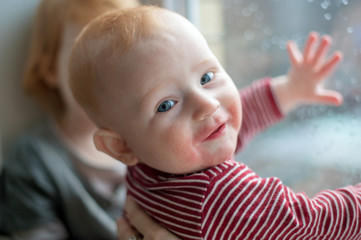 Baby with manifestations of food allergy on the face