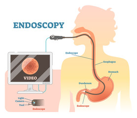 Endoscopy anatomical vector illustration diagram, medical scheme.