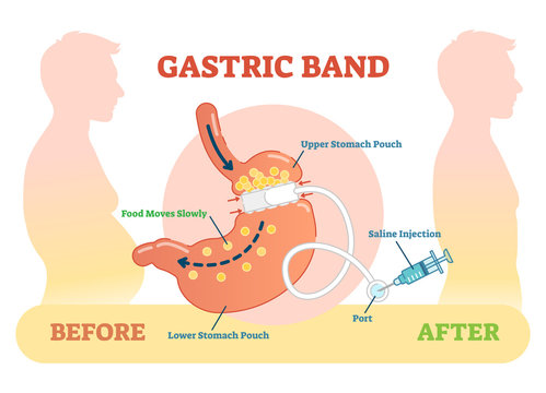 Gastric Band anatomical vector illustration diagram, medical before  after scheme.