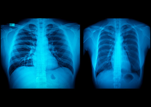 X-Ray Image Of man Chest  and Women Chest for Check Anomaly of the body