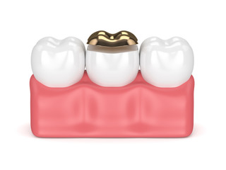 3d render of teeth with dental golden onlay filling