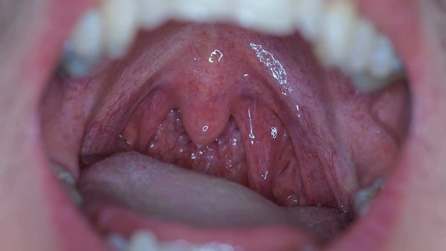 a man with an open mouth at the doctor shows tonsils and tongue