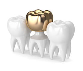 3d render of teeth with dental golden crown filling
