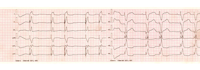 ECG with pacemaker arrhythmia (ventricular stimulation)
