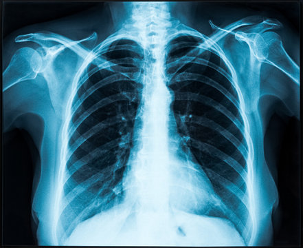 X-ray of an Older Woman's Chest