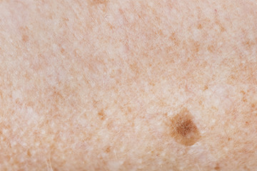 Closeup of freckled skin