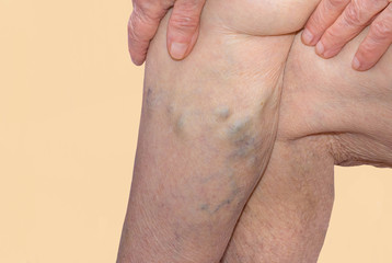 The varicose veins on a legs of old woman on blue