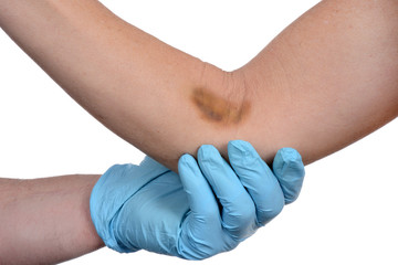 
Doctor treating patient with a arm bruise isolated white background
