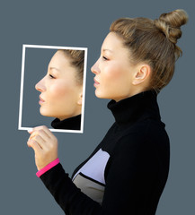 Rhinoplasty.Before and after