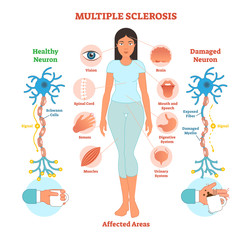 Multiple sclerosis anatomical vector illustration diagram, medical scheme. - obrazy, fototapety, plakaty