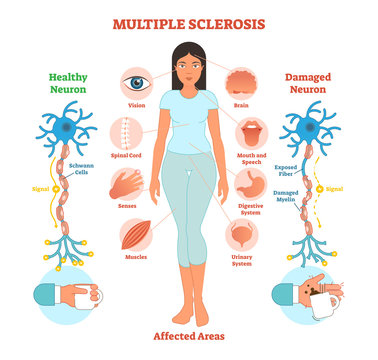 Multiple sclerosis anatomical vector illustration diagram, medical scheme.