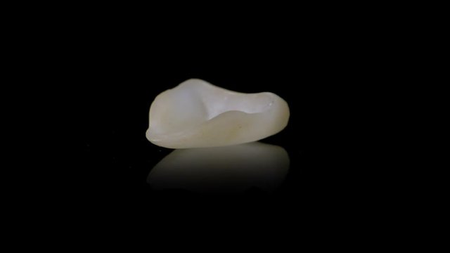 Zahn Veneer ( Verblendschale ) aus Keramik
