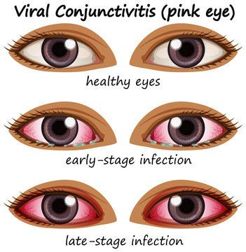 Viral conjuctivitis in human eyes