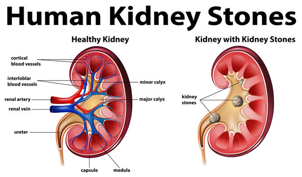 Human anatomy diagram with kidney stones