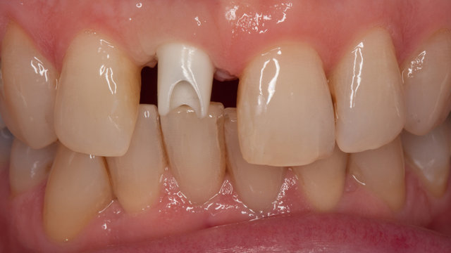 Implantatkrone Abutment aus Zirkon