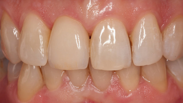 Implantatkrone