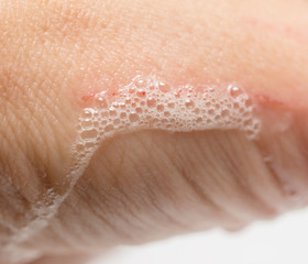 a scratch on the arm