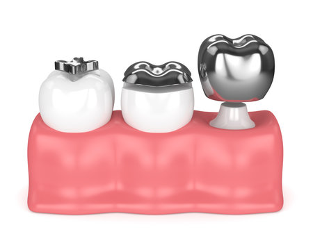 3d render of teeth with different types of dental amalgam filling