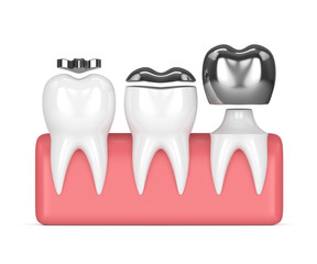 3d render of teeth with different types of dental amalgam filling