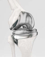Knee with modern knee prosthesis - 3D Rendering