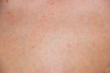 pigment spots on the skin of women
