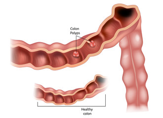 Colon polyps. Vector illustration