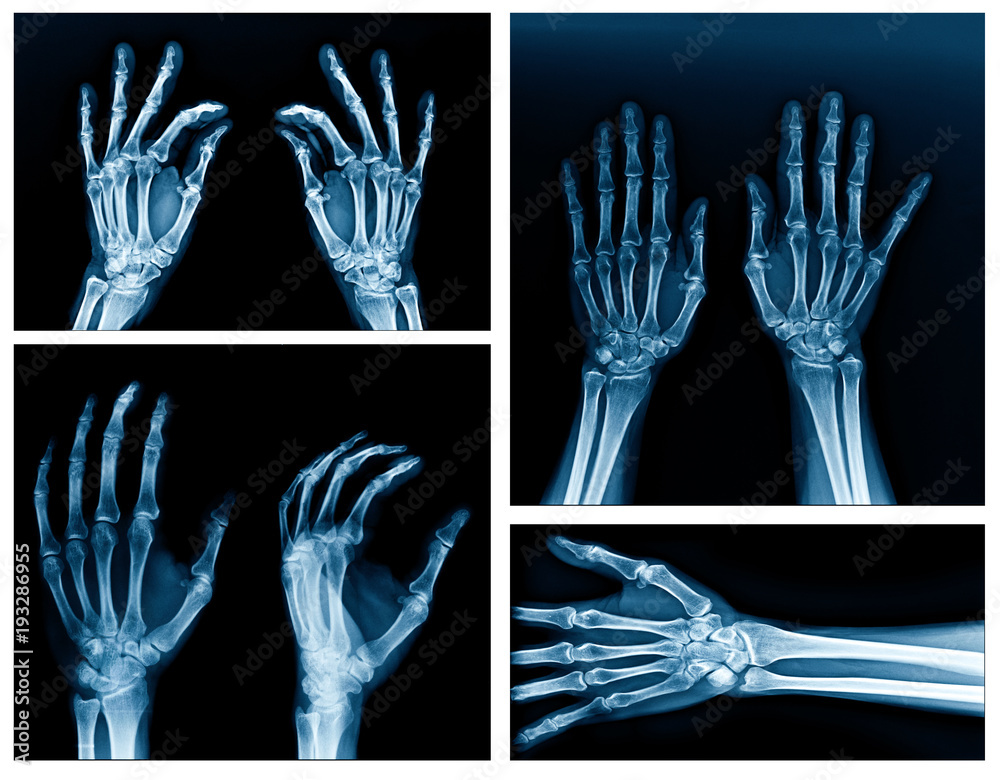 Canvas Prints collection hand x-ray high quality picture