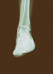 Right ankle x-ray. Back scan
