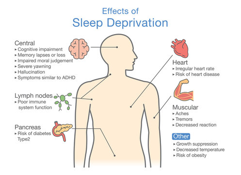 Diagram of Effects of Sleep deprivation. Illustration about disease diagnosis. 