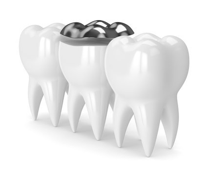 3d render of teeth with dental onlay amalgam filling
