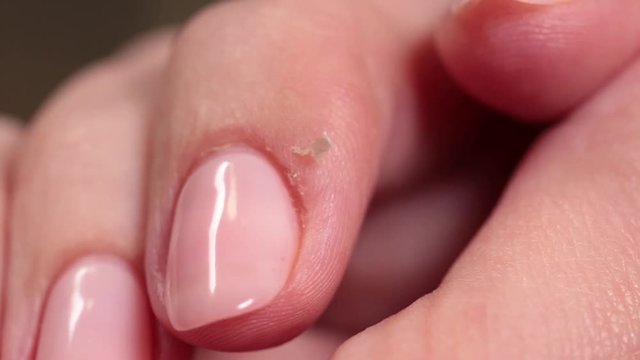 Closeup view of female fingers with unfresh manicure and dry big hangnail on one finger.