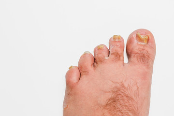 A toenail fungus