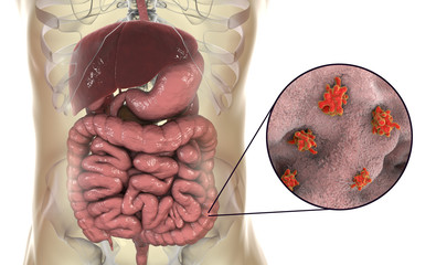 Entamoeba histolytica protozoan infection of large intestine. Parasite which causes amoebic dysentery and ulcers. 3D illustration
