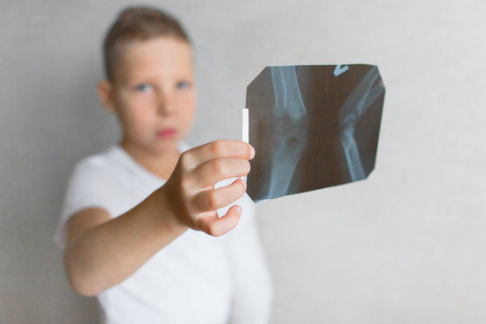 The boy with a broken hand looks at the X-ray. X-ray in the hands of a sad boy with a broken arm.