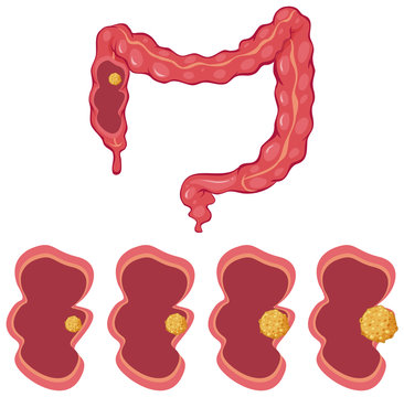 Colon and cancer process
