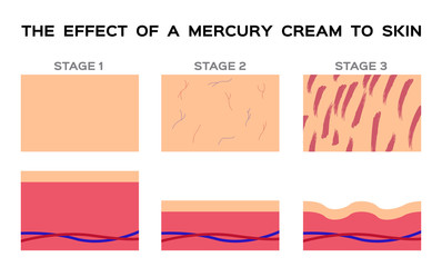 dangerous mercury cream damaged human skin vector