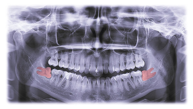 x-ray of teeth, molar tooth improperly growing