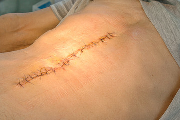 Abdomen scar after surgery